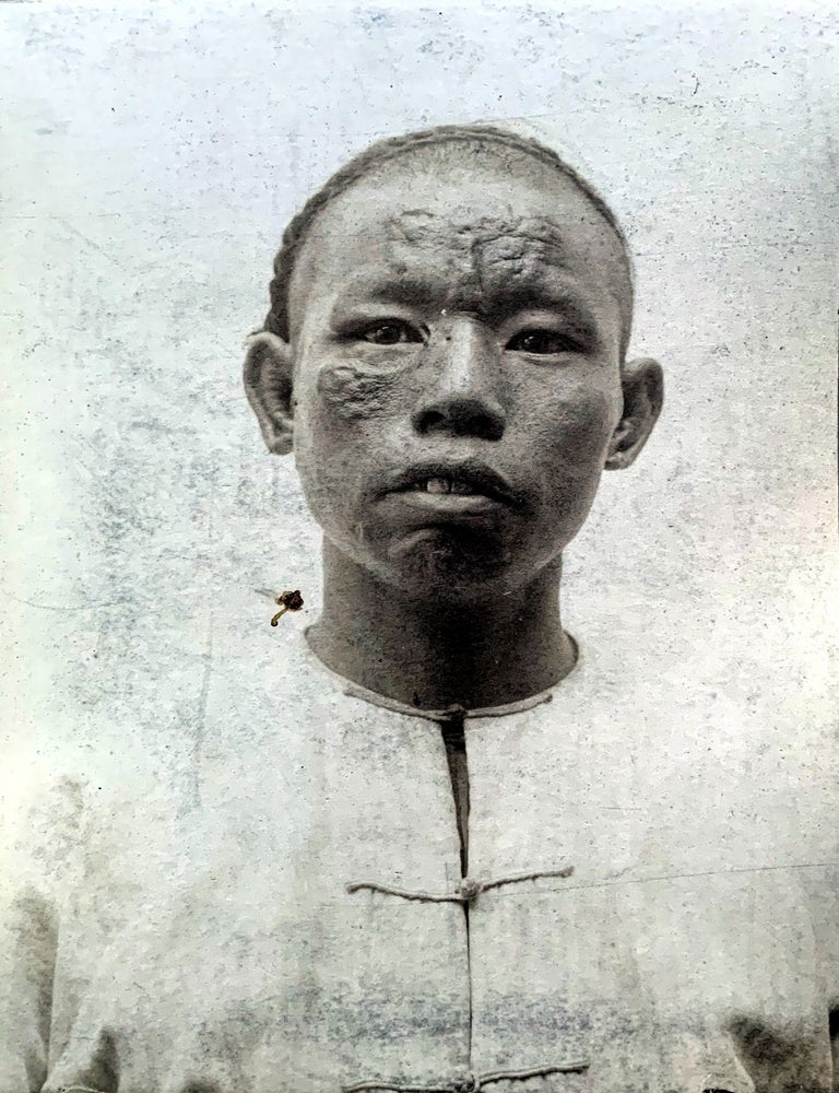 Item #17863 Tubercular, anaestetic and mixed tuberculous types of Hawaiian lepers. (offered with) &ldquo;Illustrations of the principal phenomena of leprosy.&rdquo; From Atlas of illustrations of clinical medicine, surgery and pathology. Fasciculus XVIII. London: The New Sydenham Society, [1903-4]. James T. WAYSON.