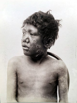 Tubercular, anaestetic and mixed tuberculous types of Hawaiian lepers. (offered with) &ldquo;Illustrations of the principal phenomena of leprosy.&rdquo; From Atlas of illustrations of clinical medicine, surgery and pathology. Fasciculus XVIII. London: The New Sydenham Society, [1903-4].