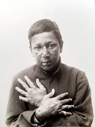 Tubercular, anaestetic and mixed tuberculous types of Hawaiian lepers. (offered with) &ldquo;Illustrations of the principal phenomena of leprosy.&rdquo; From Atlas of illustrations of clinical medicine, surgery and pathology. Fasciculus XVIII. London: The New Sydenham Society, [1903-4].