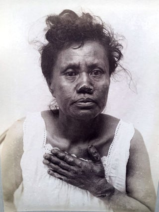Tubercular, anaestetic and mixed tuberculous types of Hawaiian lepers. (offered with) &ldquo;Illustrations of the principal phenomena of leprosy.&rdquo; From Atlas of illustrations of clinical medicine, surgery and pathology. Fasciculus XVIII. London: The New Sydenham Society, [1903-4].