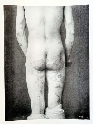 Tubercular, anaestetic and mixed tuberculous types of Hawaiian lepers. (offered with) &ldquo;Illustrations of the principal phenomena of leprosy.&rdquo; From Atlas of illustrations of clinical medicine, surgery and pathology. Fasciculus XVIII. London: The New Sydenham Society, [1903-4].