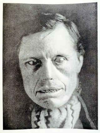 Tubercular, anaestetic and mixed tuberculous types of Hawaiian lepers. (offered with) &ldquo;Illustrations of the principal phenomena of leprosy.&rdquo; From Atlas of illustrations of clinical medicine, surgery and pathology. Fasciculus XVIII. London: The New Sydenham Society, [1903-4].