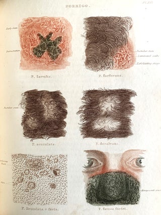 Atlas of Delineations of Cutaneous Eruptions; Illustrative of the Descriptions in the Practical. Anthony Todd THOMSON.